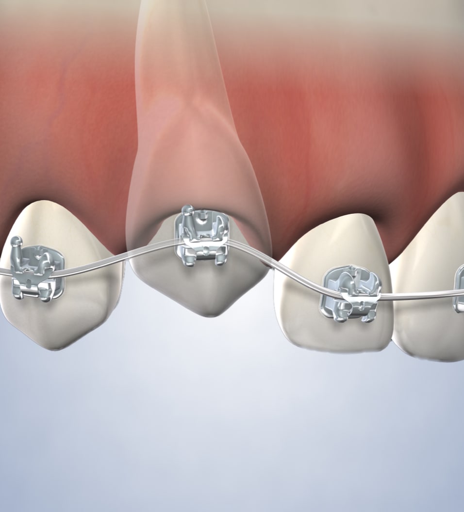 query  ortho impacted canines
