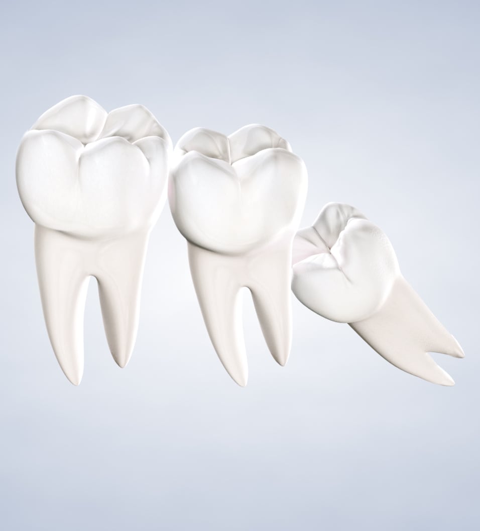 Impacted Wisdom Teeth Extractions in Walnut Creek, CA