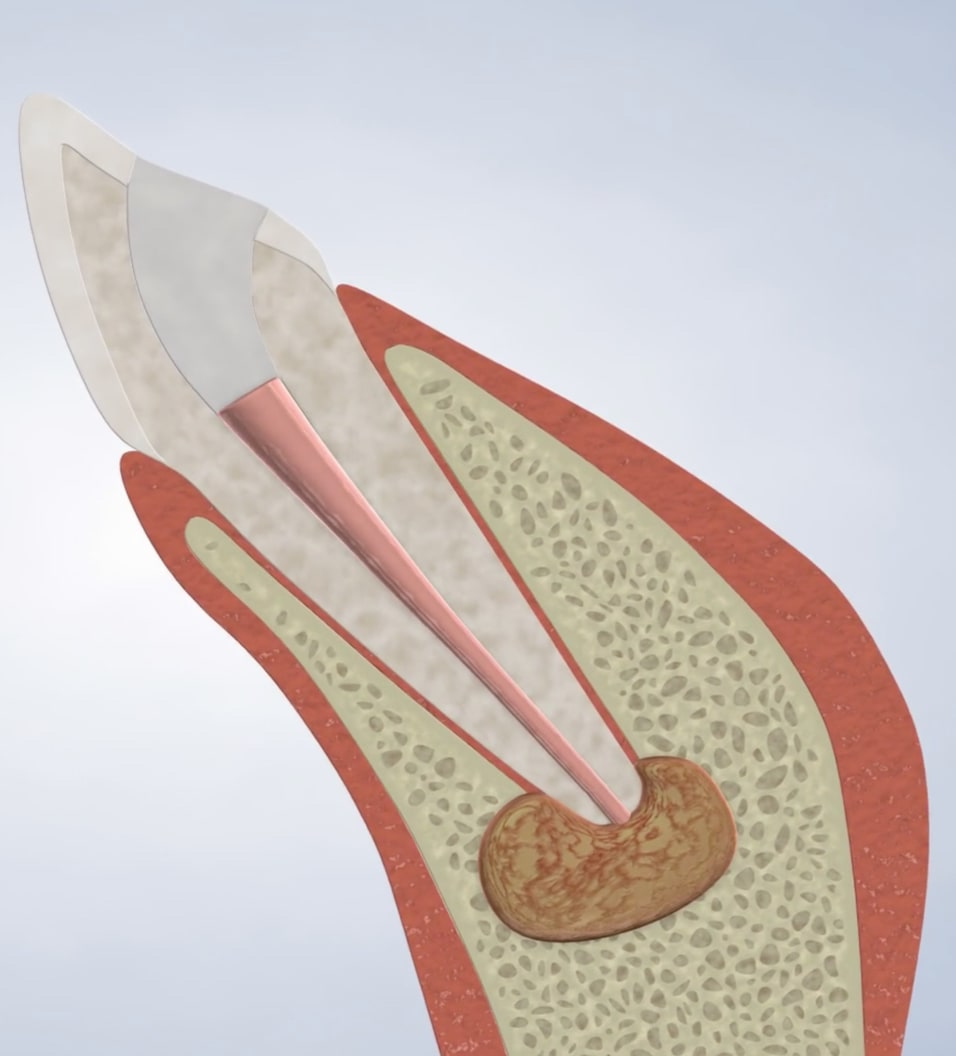 Procedure original query sleep apicoectomy