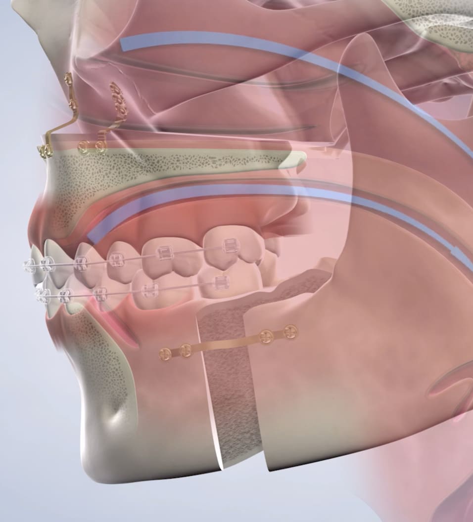 Sleep Apnea Treatment in Walnut Creek, CA
