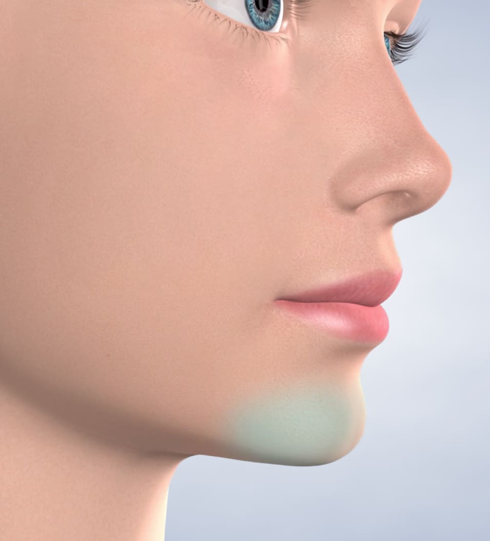 Query  chin surgery