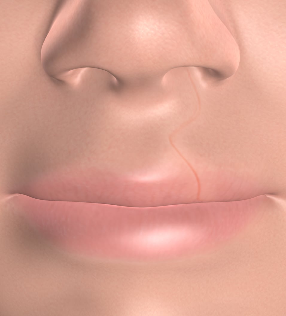 query  cleft lip and cleft palate