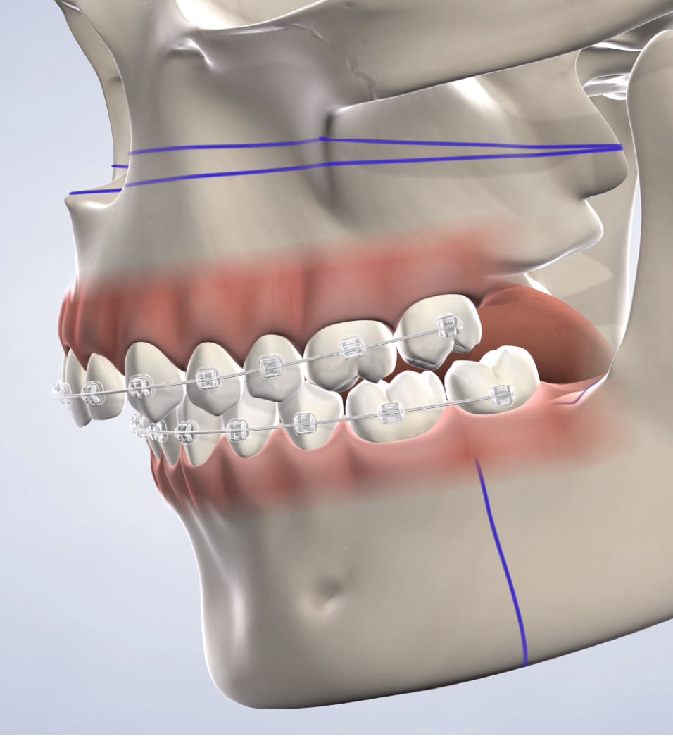 query  jaw surgery