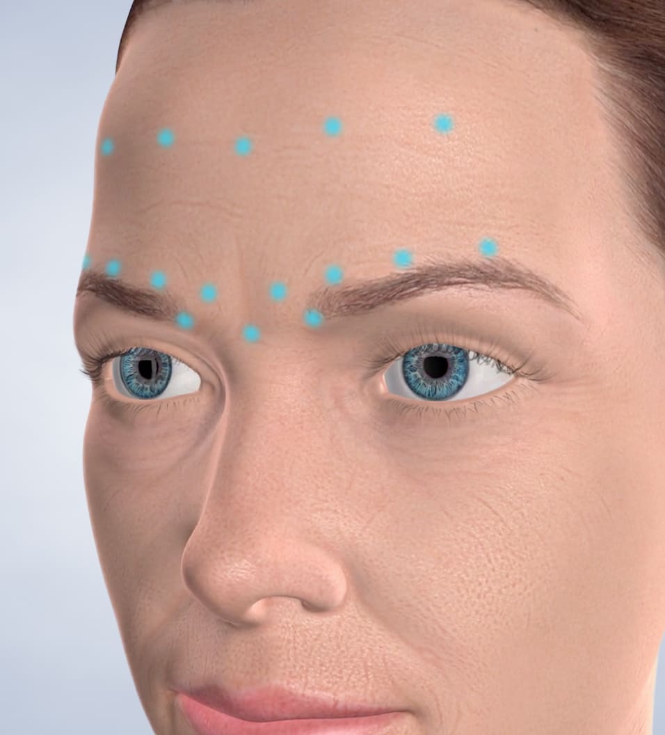 query  botox