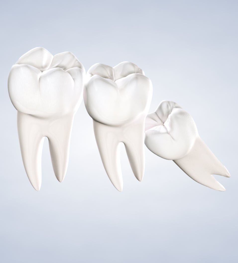 query  wisdom teeth removal