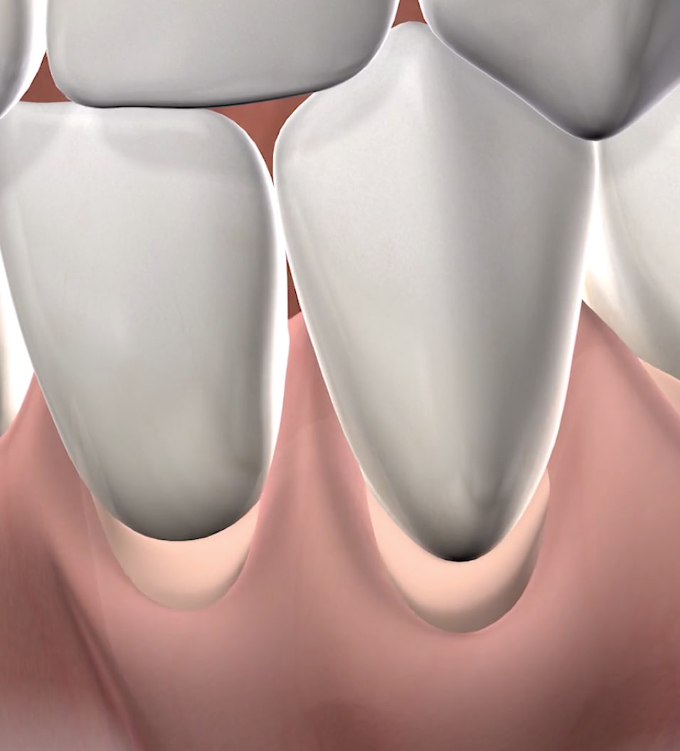 Query  crown lengthening