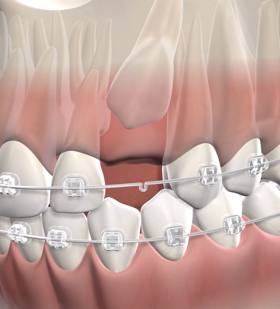 query  impacted canines2