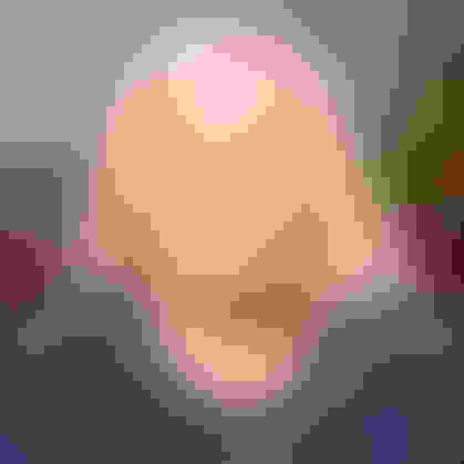 Caroline underwent a tooth extraction, bone graft, and got a dental implant placed