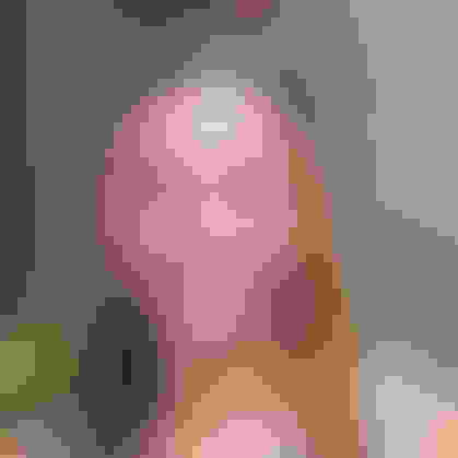 Melissa had oral surgery at Oral Surgery Group