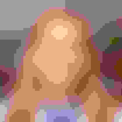 Susan had a bone graft and a dental implant placed in East Brunswick, NJ