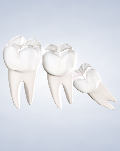 Wisdom Teeth Removal In Charlotte Nc Extract Third Molars