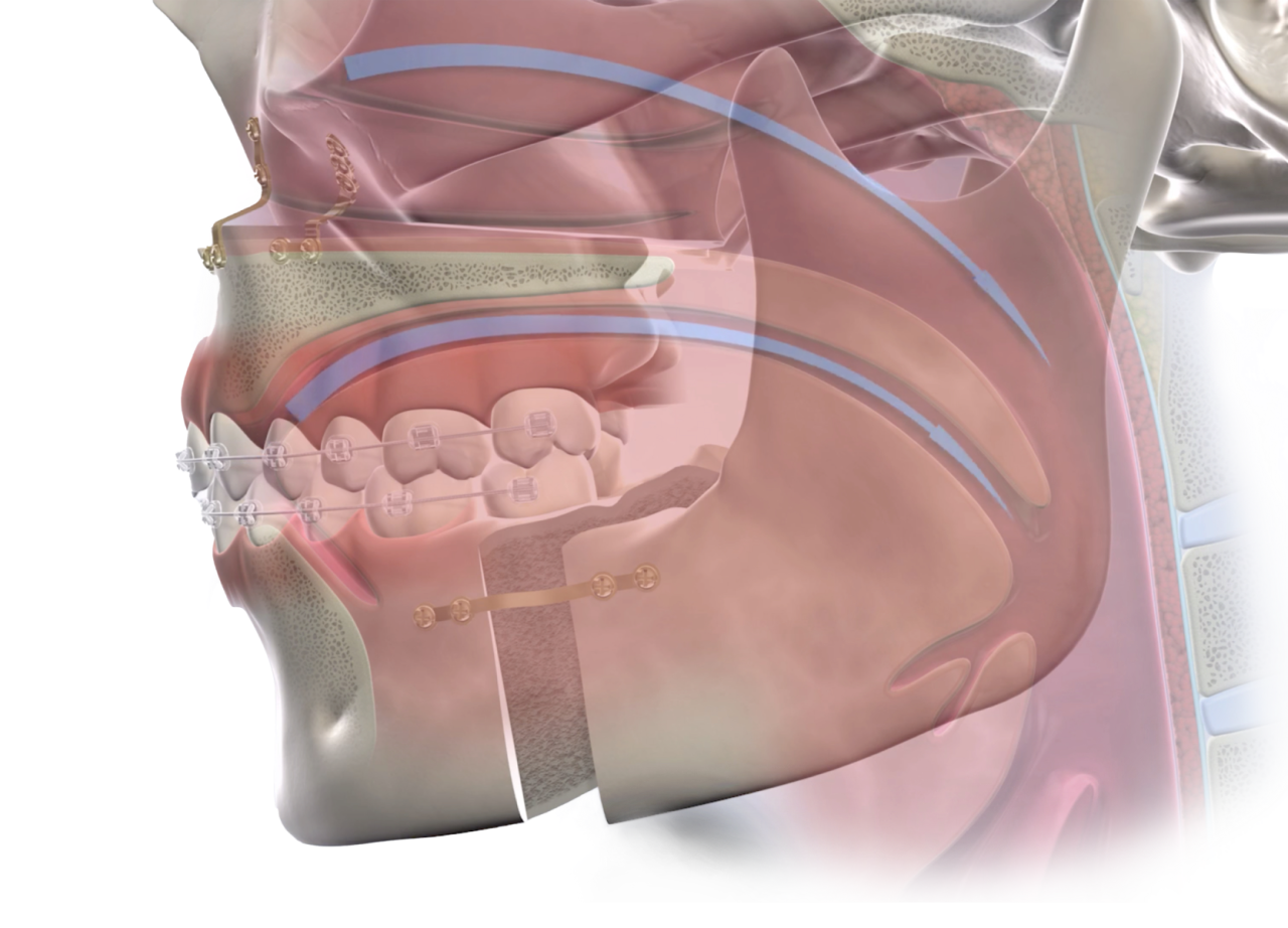 Isolated  obstructive sleep apnea