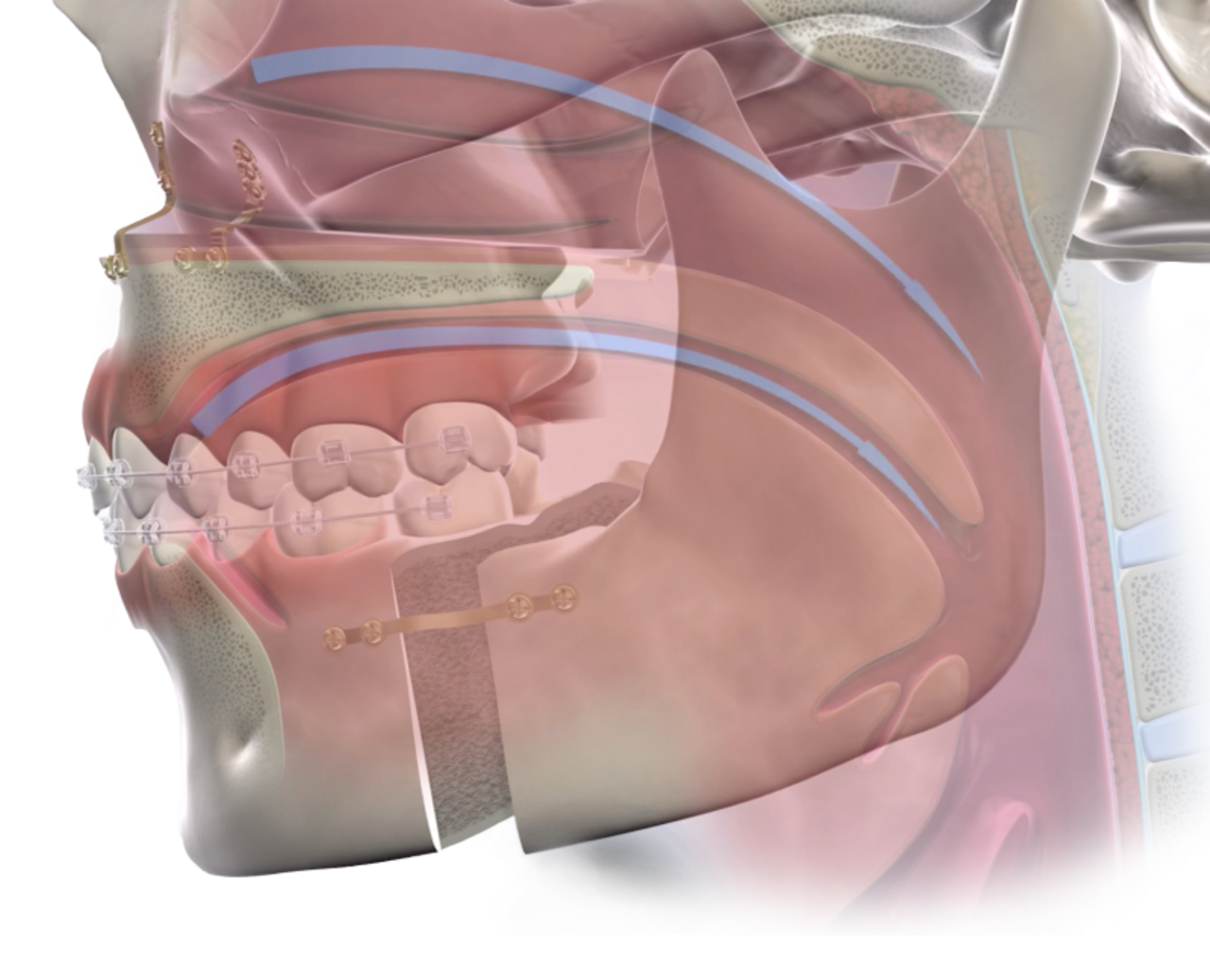 Isolated  obstructive sleep apnea  mobile