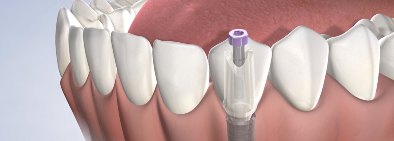 Procedure immediate dental implant video