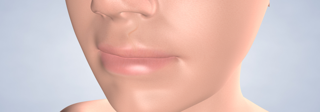 Cleft lip and cleft palate procedure desktop 1