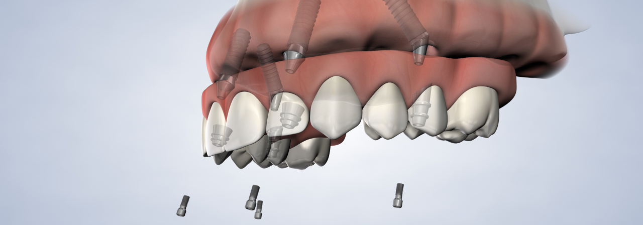 Full arch procedure desktop