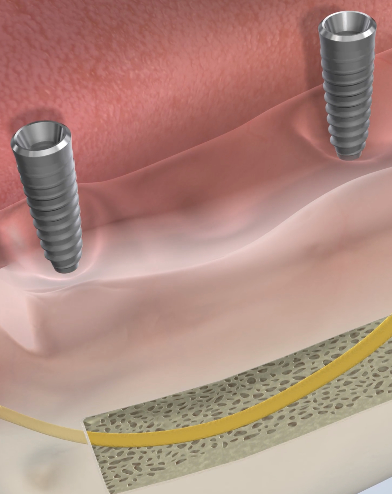 Nerve repositioning procedure mobile