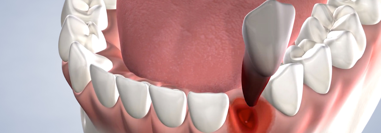 image of tooth extraction procedure