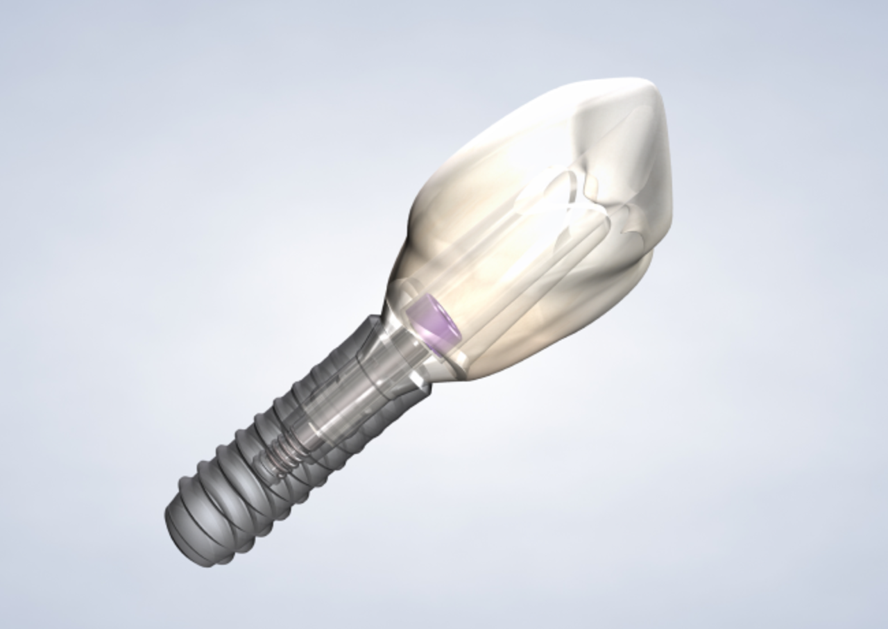 image of dental implants procedure