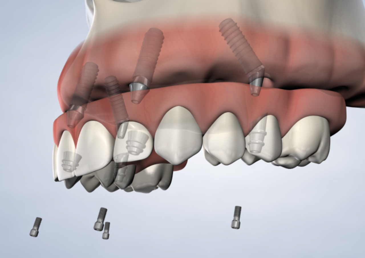 image of full-arch restoration procedure