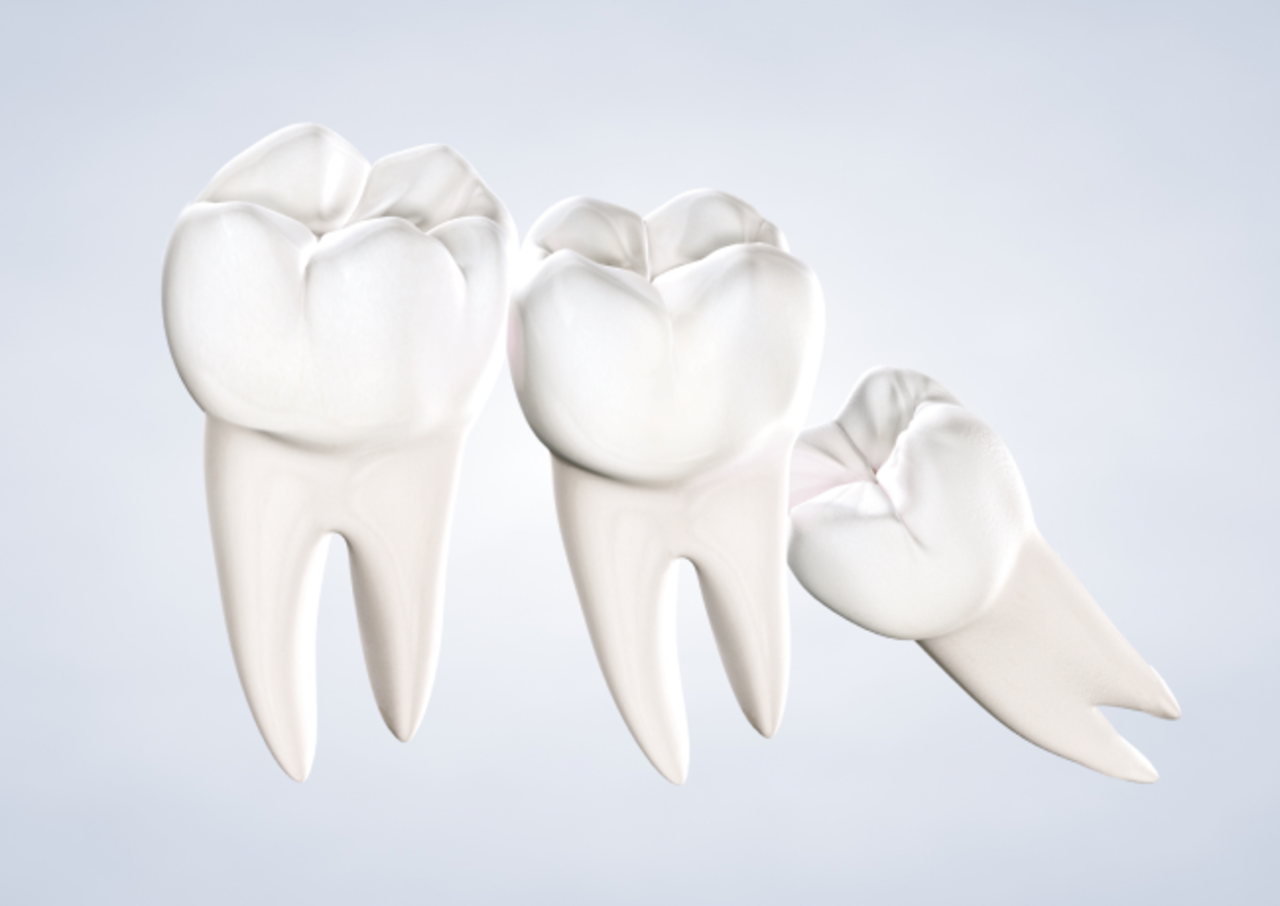 image of wisdom teeth removal procedure