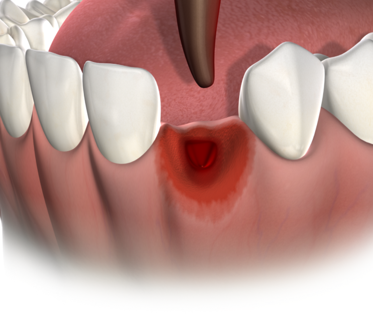 isolated  tooth extractions  mobile