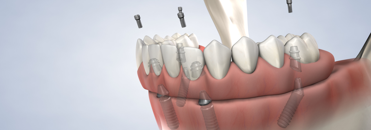 image of full-arch restoration procedure