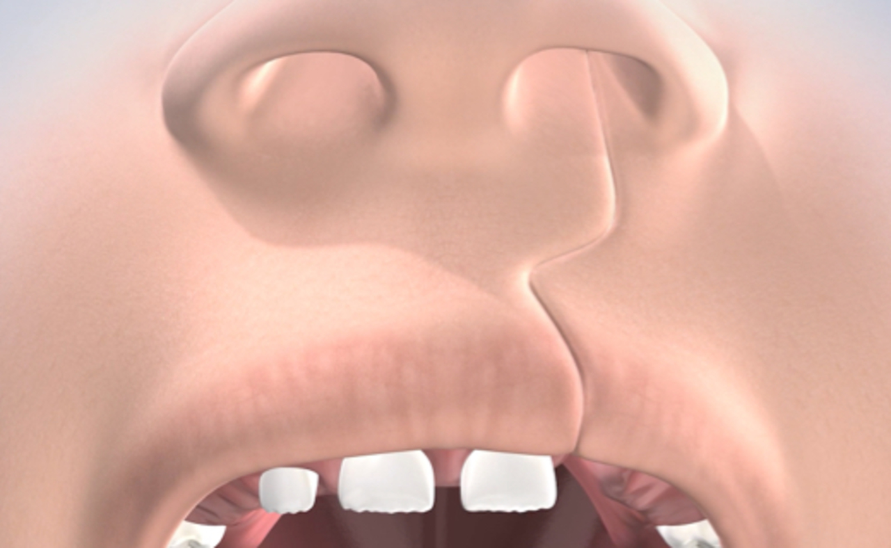 image of cleft lip & <br> cleft palate procedure