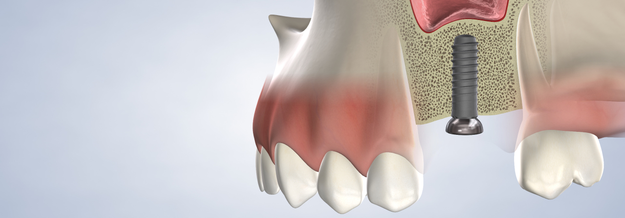 Bone grafting in New Brunswick, East Brunswick, and Middlesex, NJ