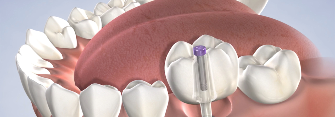 image of dental implants procedure