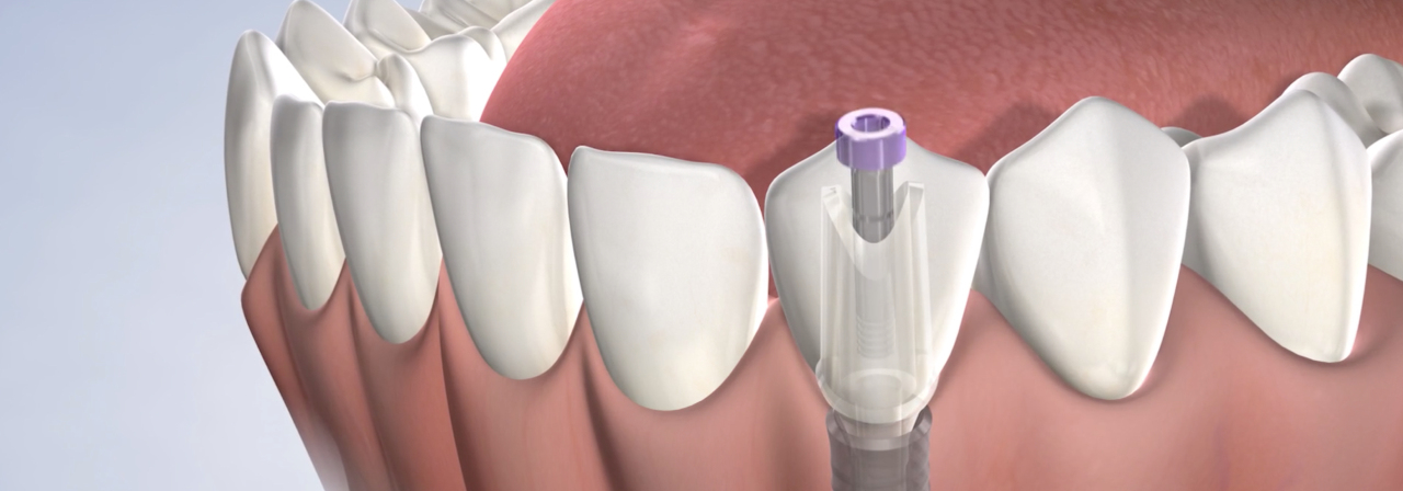 Dental implants in New Brunswick, East Brunswick, and Middlesex, NJ