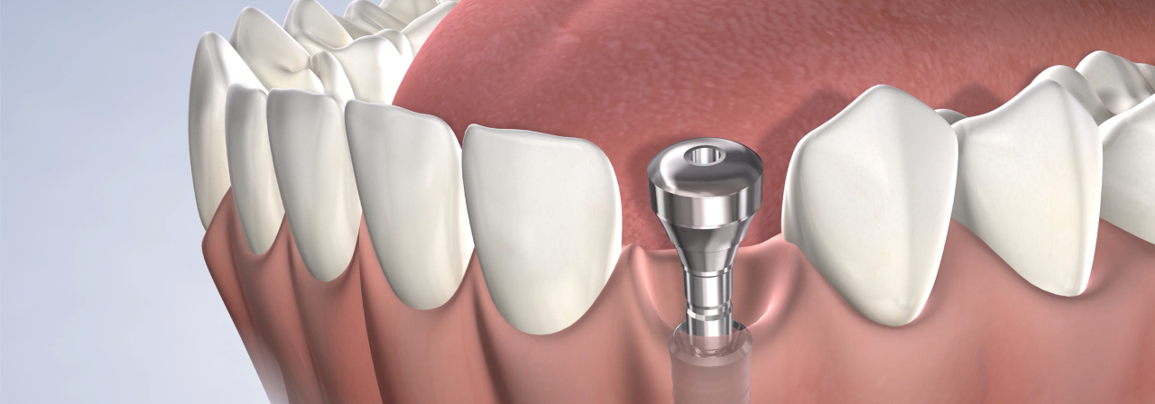 Dental implants in New Brunswick, East Brunswick, and Middlesex, NJ