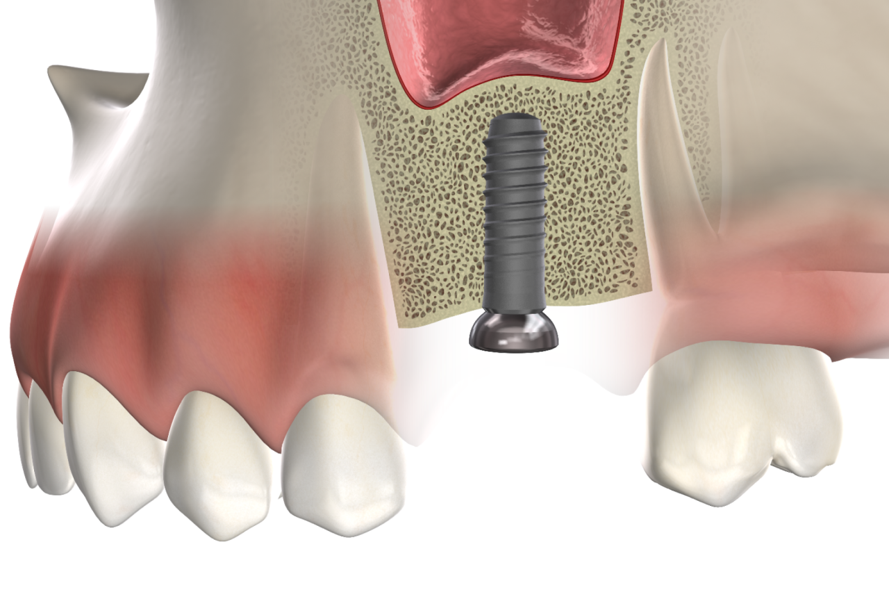 Isolated  bone grafting