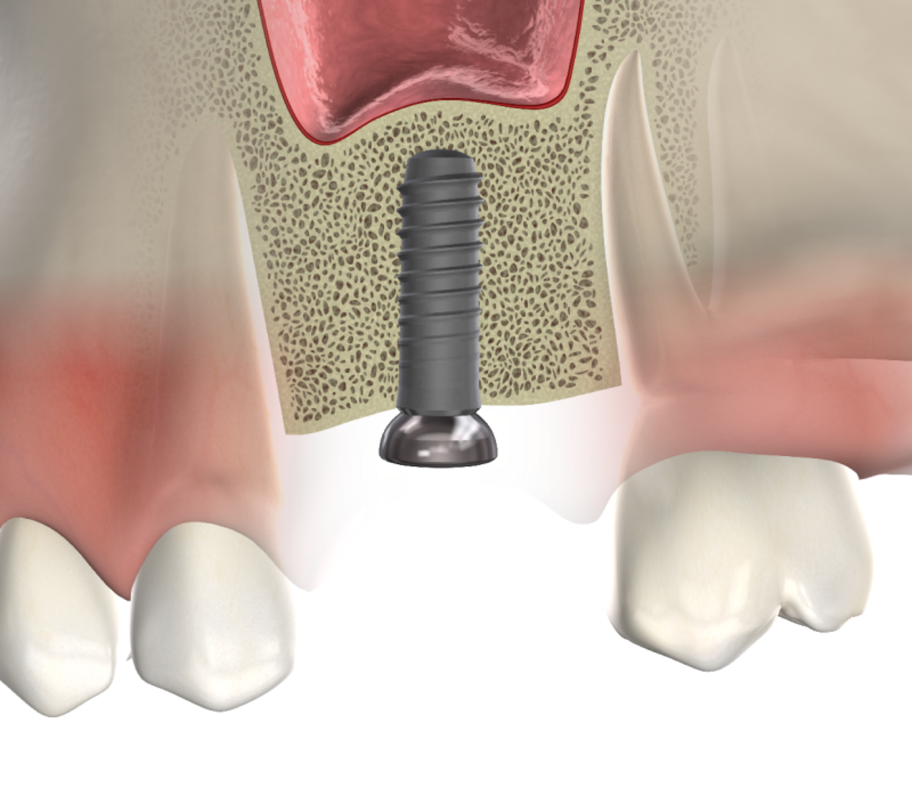 Isolated  bone grafting  mobile