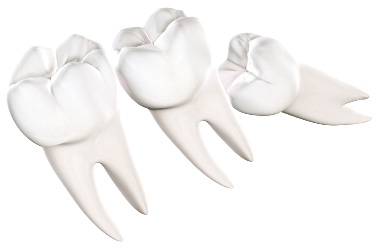 Isolated  wisdom teeth