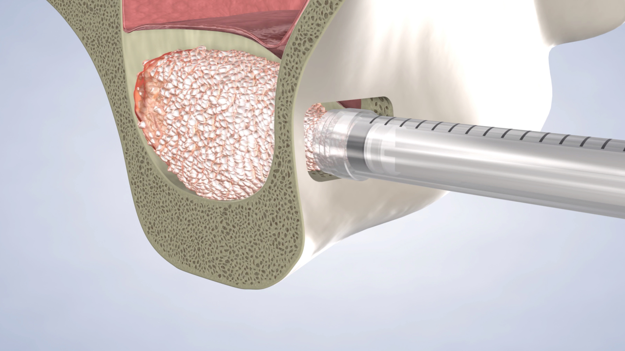 Sinus Lift in Auburn, Federal Way, Renton, Maple Valley, Puyallup, WA