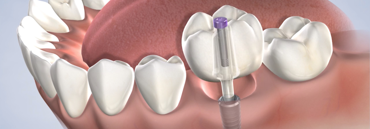 Procedure dental implants candidacy thumb