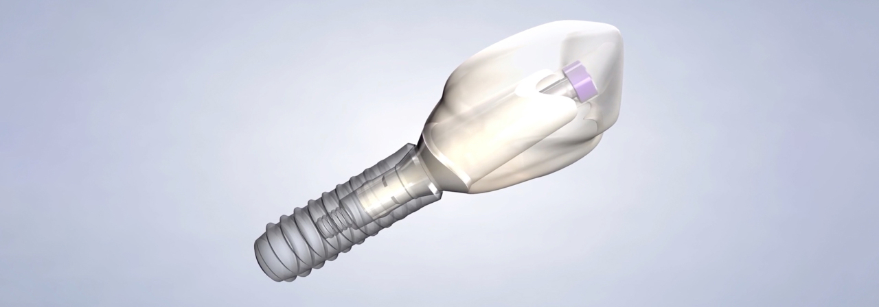 Procedure dental implants quality thumb