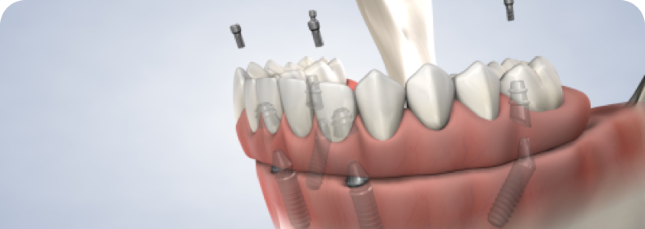 image of full-arch restoration procedure