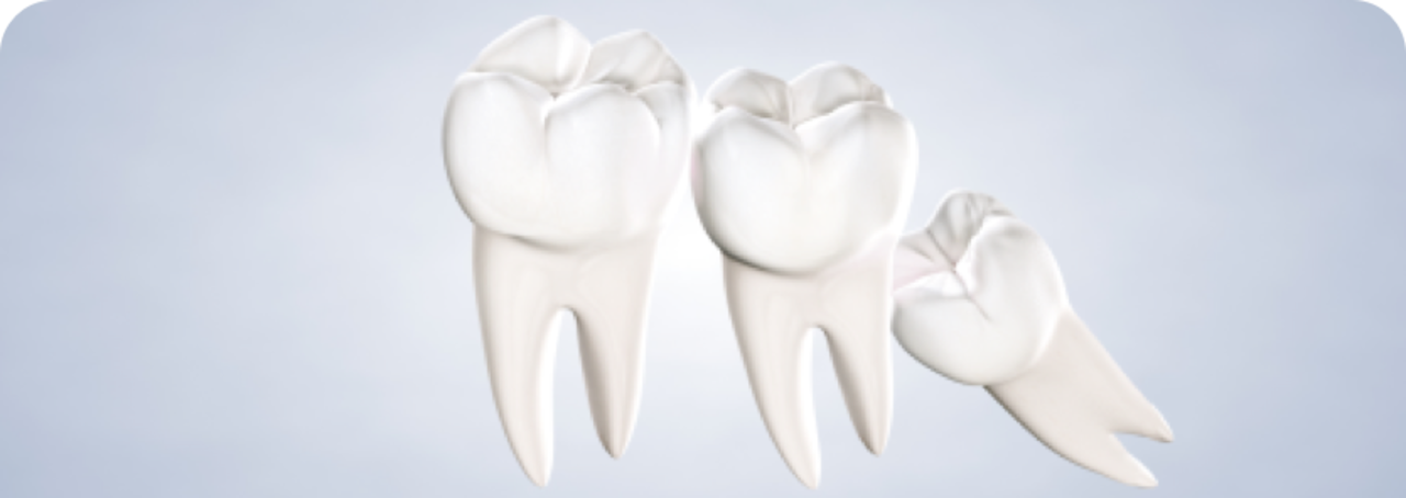 image of wisdom teeth removal procedure