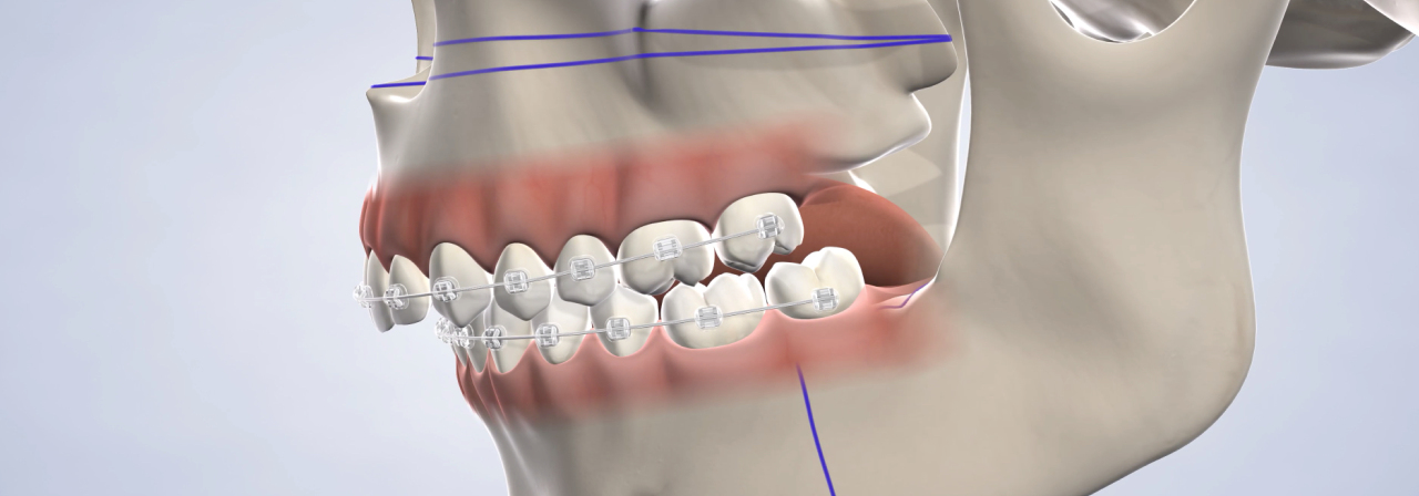image of jaw surgery procedure