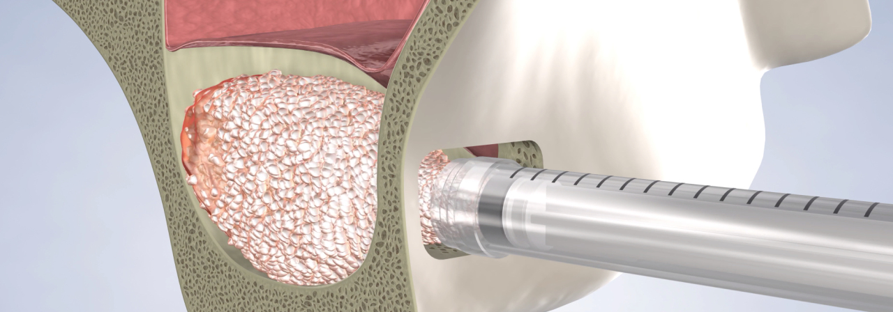 Sinus lift in Sonoma and Napa, CA