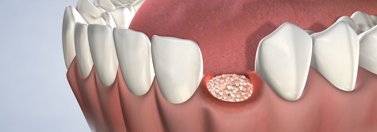 Socket preservation in Sonoma and Napa, CA