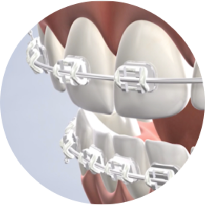 Instrucciones para protectores bucales en Nalchajian Orthodontics en  Fresno, CA, y Clovis, CA