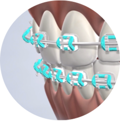 Palatal Expander in Fresno, CA, & Clovis, CA, at Nalchajian Orthodontics