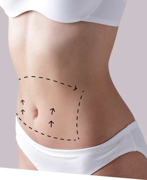 Tummy Tuck in San Francisco, CA | 77 Plastic Surgery