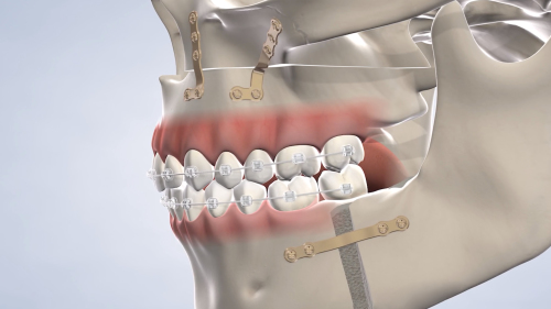 What is Jaw Surgery?, Los Angeles, CA