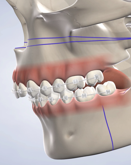 What is Jaw Surgery?, Los Angeles, CA