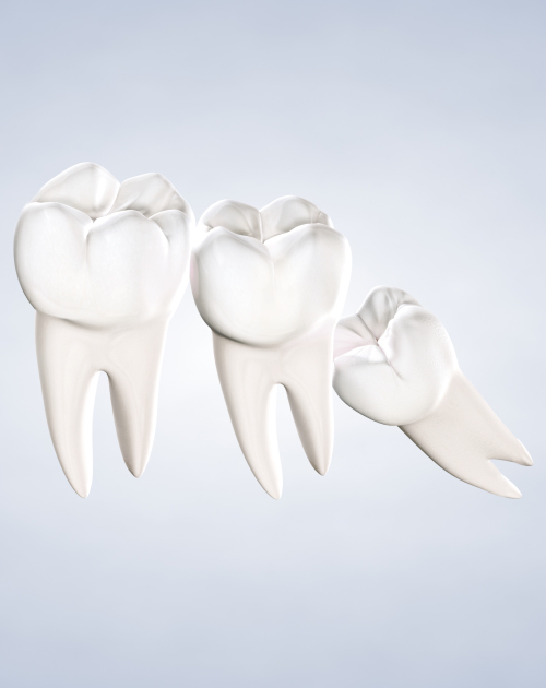 Wisdom Teeth Removal In Milwaukie Or Third Molar Extraction