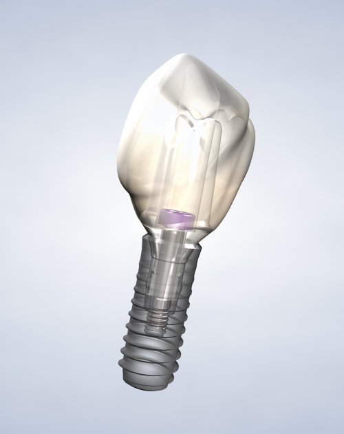 Costs For Dental Implants Lehi Utah